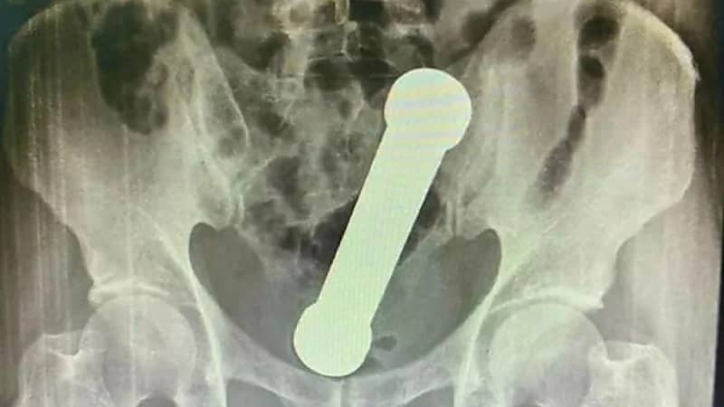 دخول دمبل في جسم مسن وإنقاذه بصعوبة