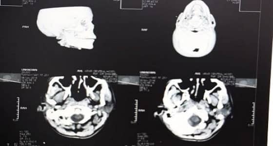 إنقاذ حياة مقيم تعرض لحادث دهس في عرعر