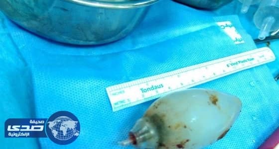 العثور على " لمبة " في أحشاء مريض بالأحساء
