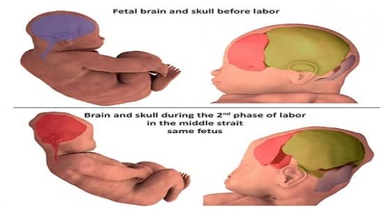 كشف ماهية " حالة صب رأس الجنين " وتأثيرها على الجمجمة