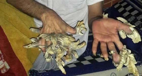 رجل يتحول إلى شجرة يابسة بسبب مرض نادر