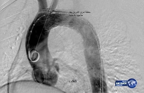  السيطرة على انفجار شريان شاب بالمدينة المنورة بطريقة "المدخنة الشريانية"