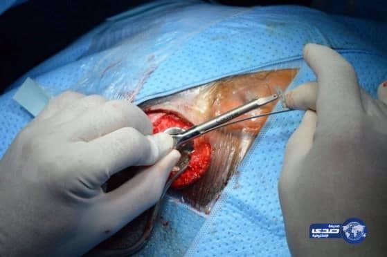 بالصور : مستشفي احد يجري اول عملية لـ زراعة السماعات العظمية "BAHA"‎