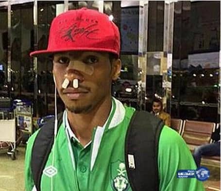 إصابة سلمان المؤشر كسر في الأنف