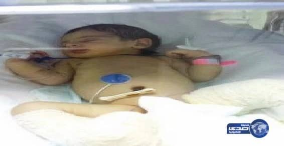 ممرضة تتسبب في حرق مولودة بالماء الساخن 