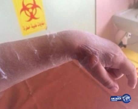 خطأ طبي بمستشفى صامطة يتسبب في الإضرار بيد طفل