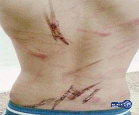 أب يكوي طفله بأسياخ الشوي في المدينة المنورة 