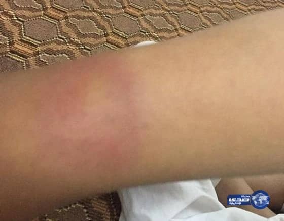 بالصور: مدير مدرسة يبرح طالباً ضرباً بـ "لي أحمر" في القصيم