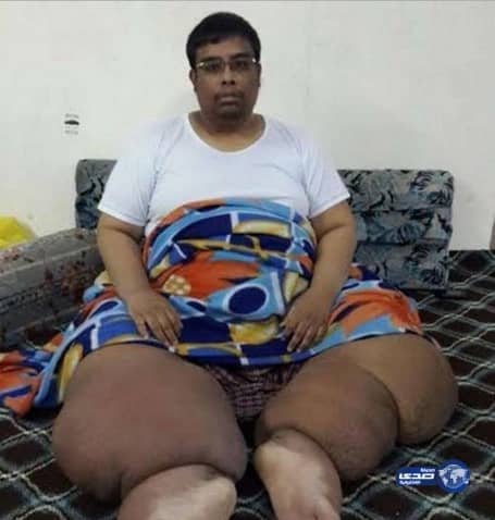 أمير المدينة يوجّه بعلاج معلم قرآن باكستاني يعاني من "داء الفيل"