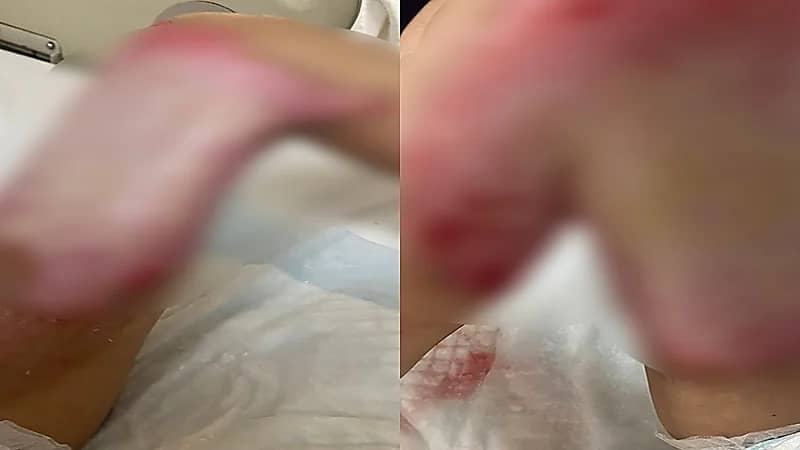 إصابة طفل كفيف بحروق بليغة.. وأمير الباحة يتدخل