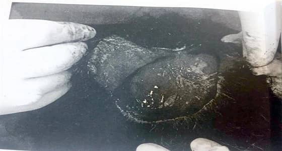 مواطنة تصاب بالصدمة بعدما سلخ الطبيب فروة رأسها خلال عملية زرع لشعرها 