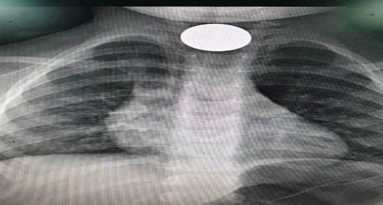 بالصور.. فريق طبي يستخرج عملة معدنية من مرئ طفل بالقنفذة