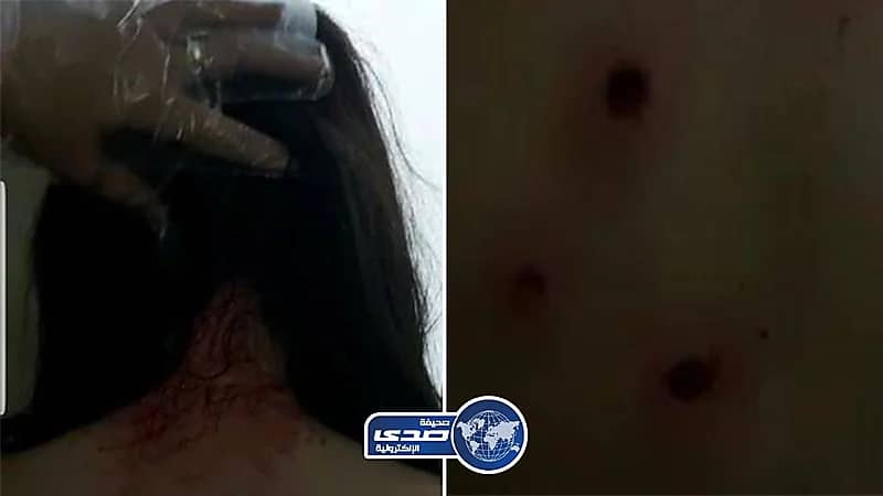 رصاصات مرتزقة الملالي تخترق جسد فتاة بطريقة بشعة