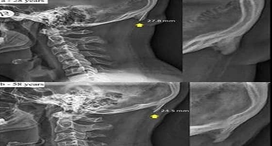 دراسة: تظهر " شوكة الجمجمة " بسبب استخدام الهواتف