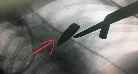 بالصور.. إصابة طفل برصاصة في الصدر بوادي الدواسر في حفل زواج