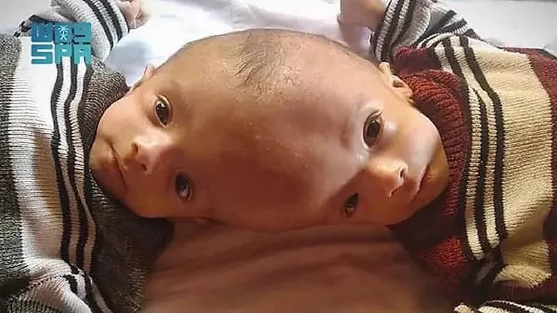 بالفيديو.. طائرة إخلاء طبي تقلع لحضرموت لنقل التوأمين السياميين اليمني للرياض