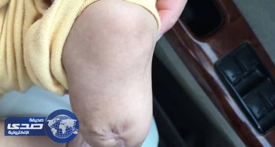 «الهيئة الشرعية» تحقق في واقعة بتر قدم الطفل «خالد»