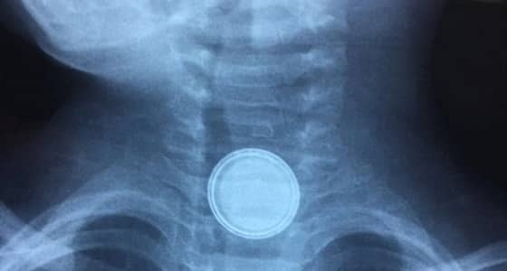 بالصور.. طفل يبتلع " بطارية حديدية " في عرعر