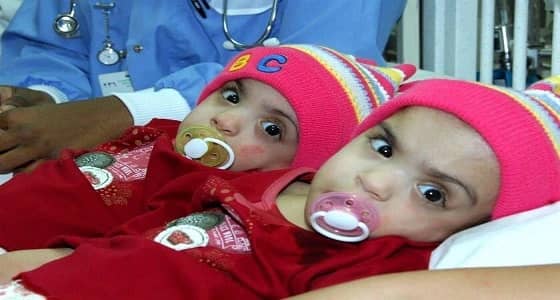 صورة للتوأم السيامي العماني " صفاء ومروة " بعد فصلهما في المملكة قبل 11 عامًا