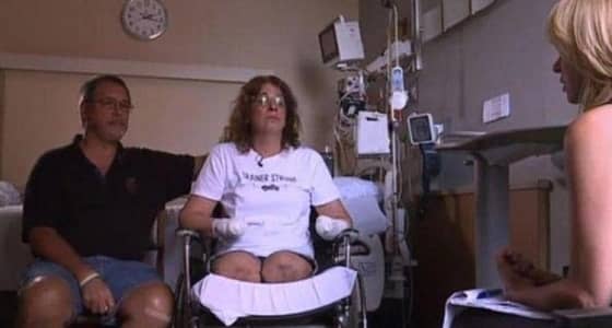 بتر أطراف امرأة أصيبت بعدوى من كلابها الأليفة