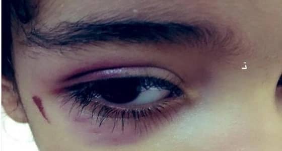 التحقيق في تعرض طفلة للإصابة بعينها داخل الروضة