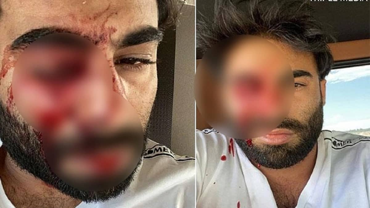 عبودكا يكشف تفاصيل إصابته بعد الاعتداء عليه: " عيني راحت مني "