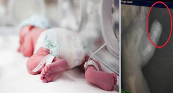 أب يتفاجأ ببتر إصبع مولودته..والمستشفى: كانت ترضع إصبعها وقطعته!