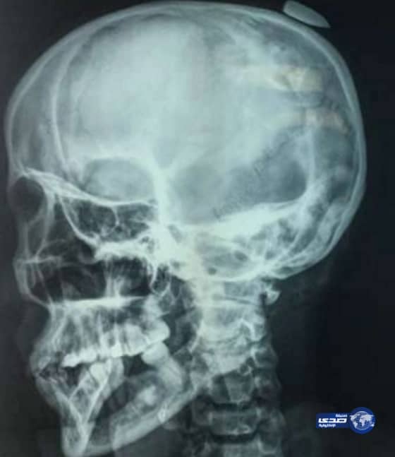 "طلقة طائشة" تخترق رأس مواطنة أربعينية بطريف