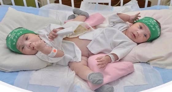 بدء عملية فصل التوأم السيامي السعودي " شيخة وشموخ "