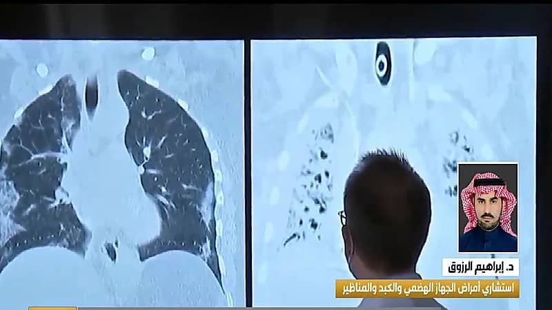 بالفيديو .. استشاري يوضح أبرز الأسباب للإصابة بقرحة المعدة