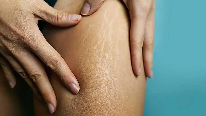 فوائد غير متوقعة لـ "السيلوليت" !