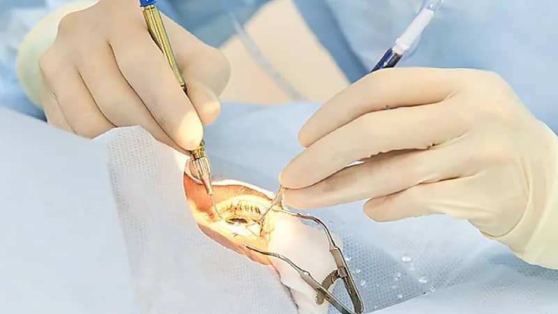 5 علامات تستدعي من الخاضعين لعملية زراعة القرنية الذهاب للطبيب فورا