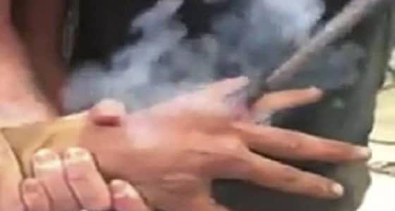 بالصور.. رجل يتخلص من وشم الزواج بحرق إصبع