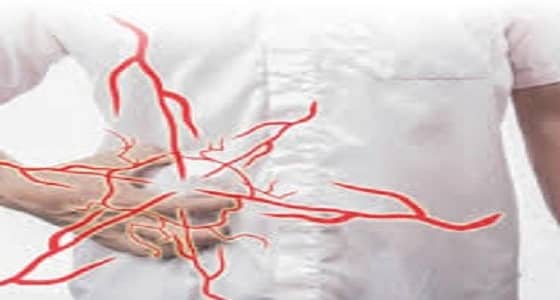 بالفيديو.. الفتاق .. أنواعه وأسباب الإصابة به