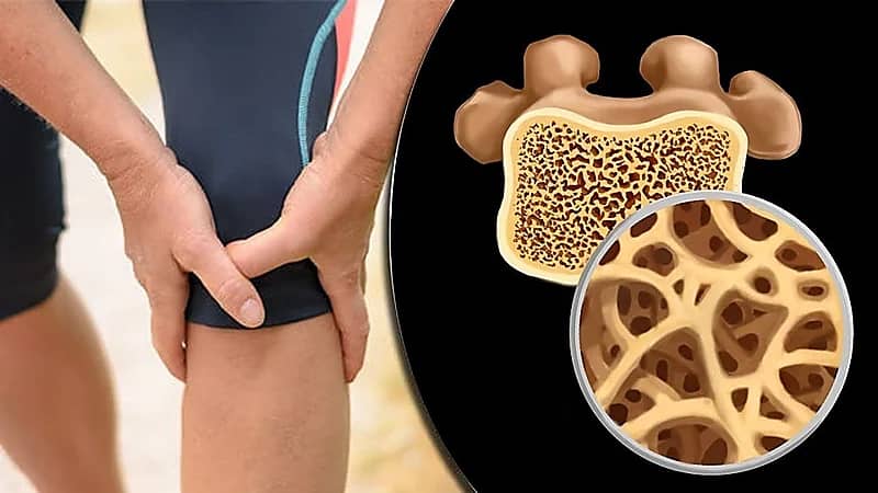 4 طرق للوقاية من هشاشة العظام
