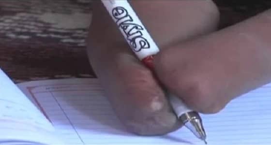 بالفيديو.. معاناة طفل يمني بعد بتر ثلاثة أطراف من جسده