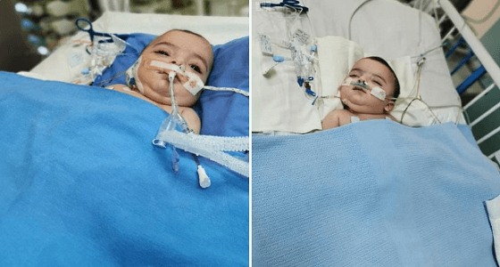 استقرار حالة التوأم السيامي الليبي «أحمد ومحمد»