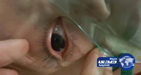 بالفيديو.. قلم رصاص طوله 15 سم يخترق عين طفل 3 سنوات ويستقر داخل مخه