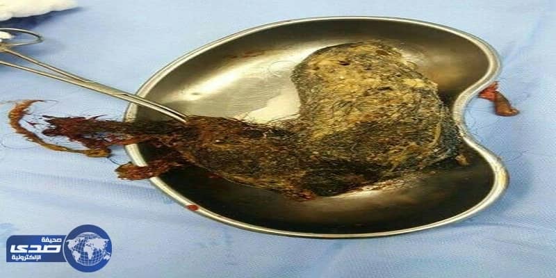 استخراج كيس شعر يزن كيلو جرام من بطن أربعينية بصبيا