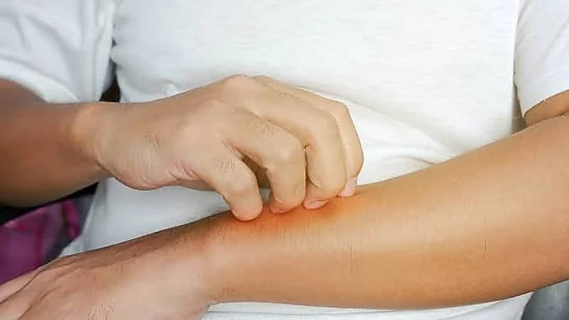 "سعود الطبية" توضح المقصود بـ حساسية الماء