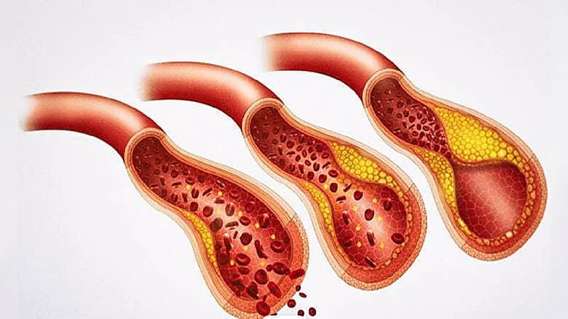 أبرزها السمنة.. أسباب ارتفاع الدهون الثلاثية