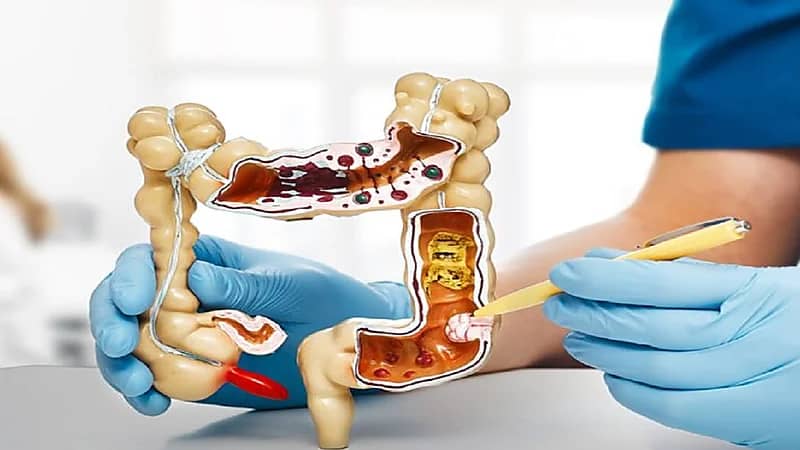 5 علامات تشير للإصابة بسرطان القولون .. فيديو