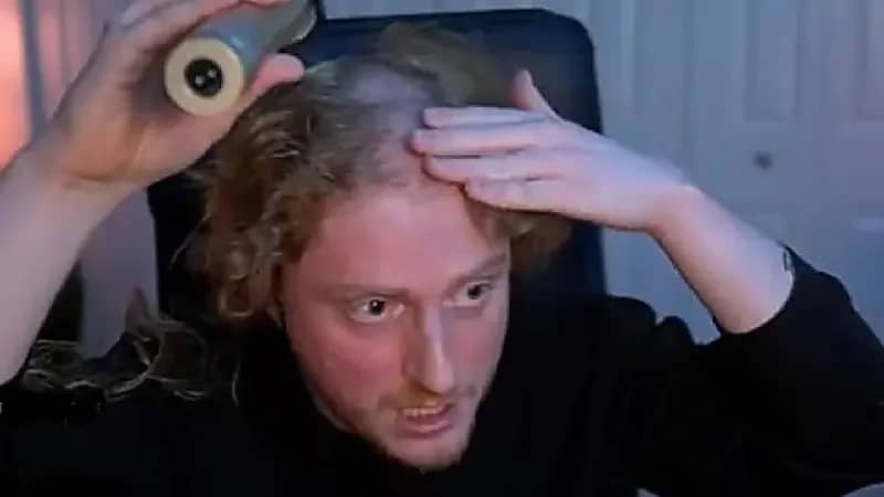 شاب يتفاجأ بفجوة في رأسه بسبب ألعاب الكمبيوتر.. فيديو