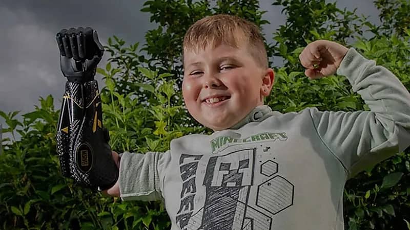 طفل يذهب للصيد لأول مرة في حياته بعد حصوله علي ذراع إلكترونية في بريطانيا