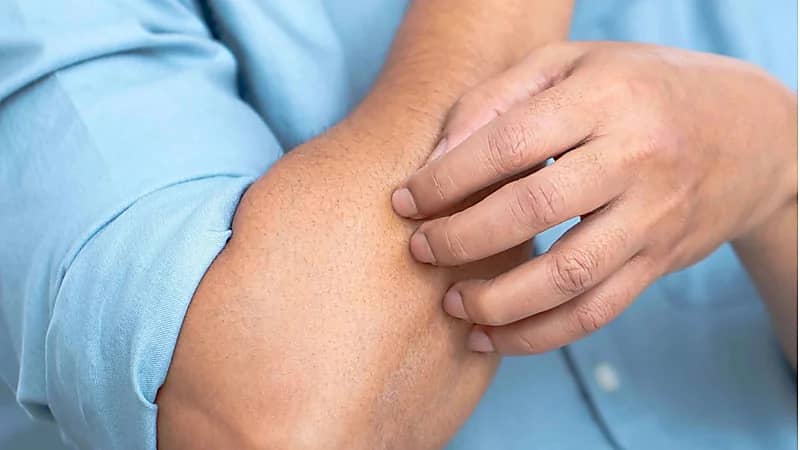 خبراء الجلدية يحذرون مرضى "التقرن الشعري" من حكّ الجلد المصاب