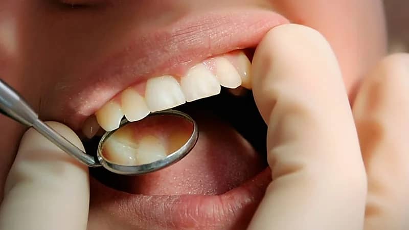 استشاري: تسوس الأطفال الحاد يكون عند الإصابة قبل 3 سنوات ..فيديو