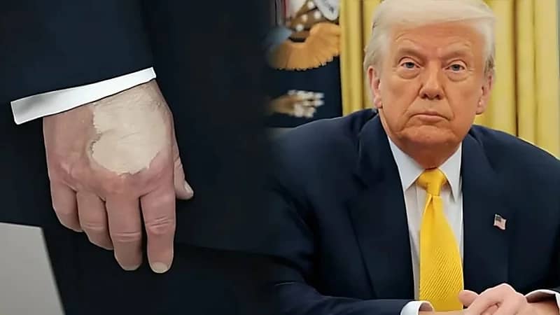 مخاوف حول صحة ترامب بعد ظهور بقعة غريبة على يده