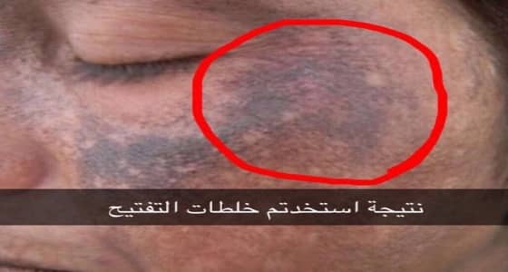 " الخضيري " يحذر من الكريمات والخلطات الشعبية مجهولة المصدر