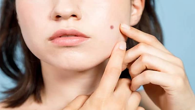 مختص: ‏بعض الشامات يمكن أن تكون قاتلة