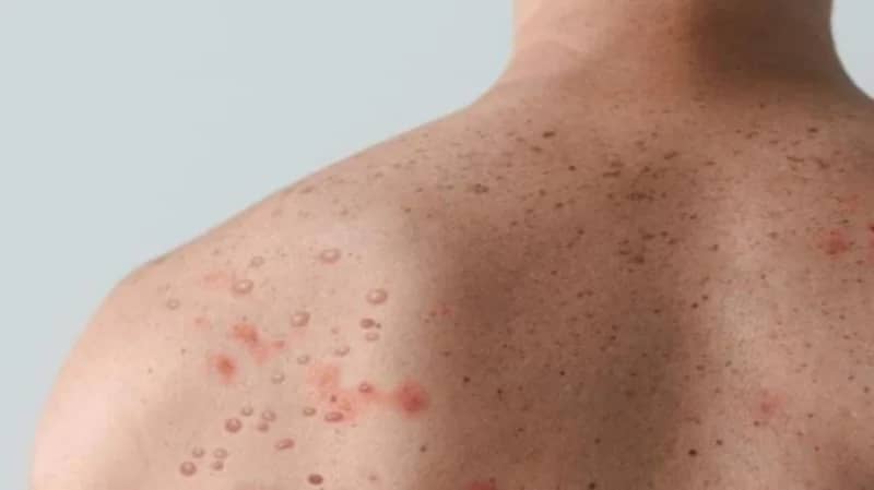 "الصحة العالمية" تتوقع المزيد من الوفيات بسبب جدري القرود